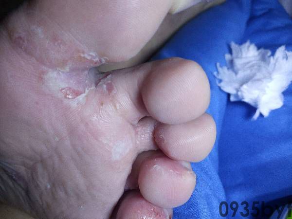 掌跖角化病会不会传染