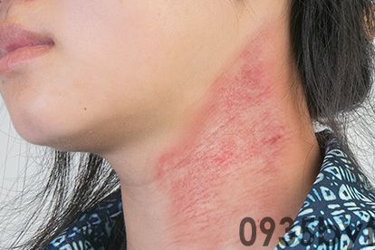 日光癣的症状图片(图1)