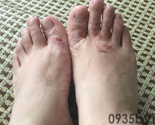 糜烂型手足癣的症状有什么