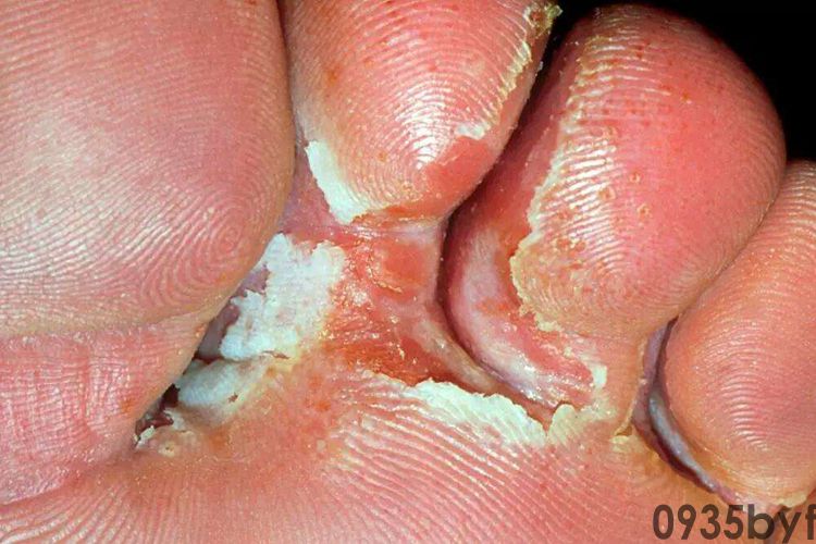 糜烂型脚气病多久治愈？