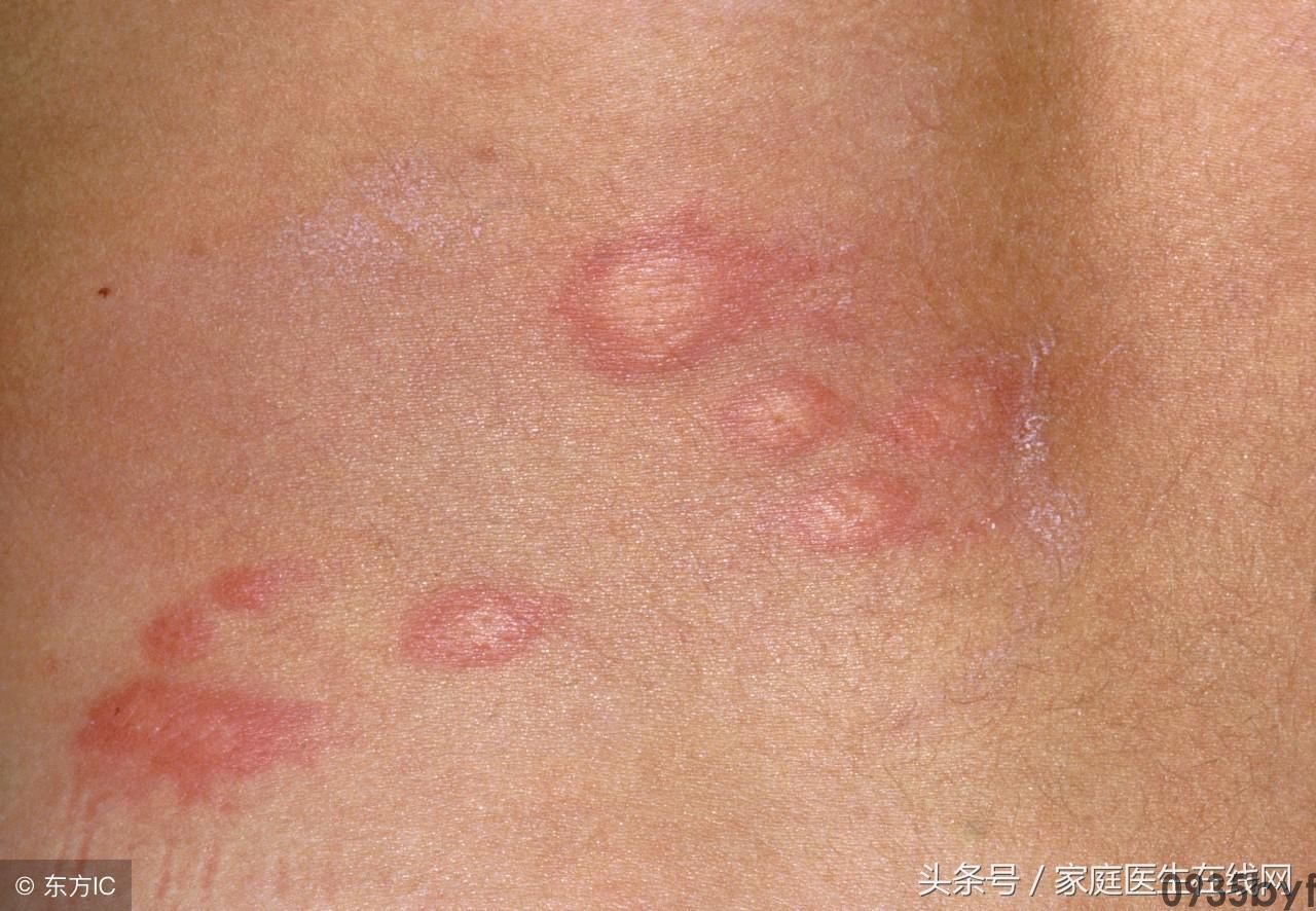 荨麻疹一个地方消退另外又长(图1) 荨麻疹一个地方消退另外又长