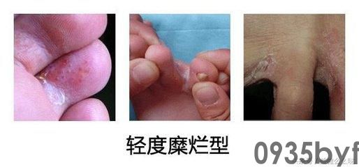 糜烂型脚气怎么去根治疗糜烂型脚气用什么药[热