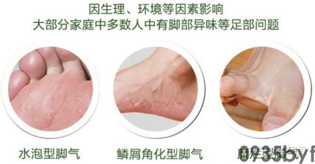 鳞屑角化型脚气如何根治(图1) 鳞屑角化型脚气如何根治