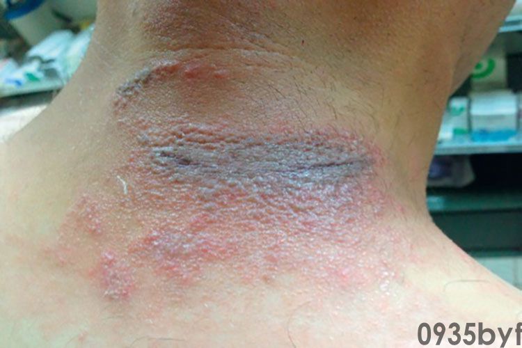 脚上长红色水泡很痒怎么回事(图1) 脚上长红色水泡很痒怎么回事