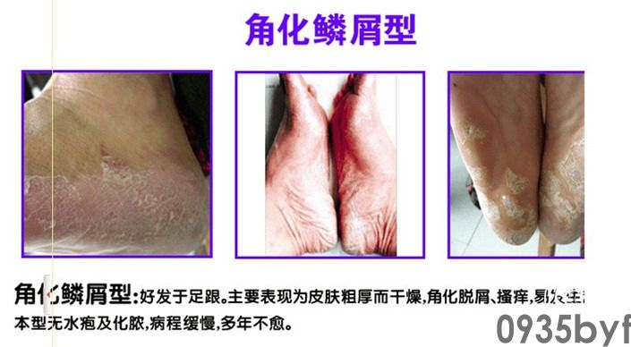 鳞屑角化型手足癣的特点及治疗方法是什么