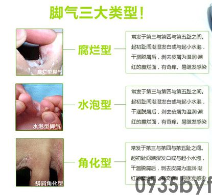 糜烂型脚气治疗方法有哪些