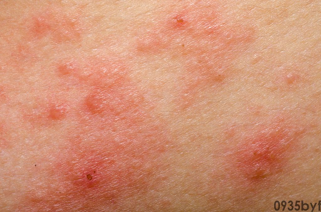 什么是红斑样皮疹