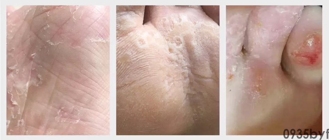 鳞屑型脚气用什么药最有效