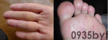 鳞屑型脚气用什么药