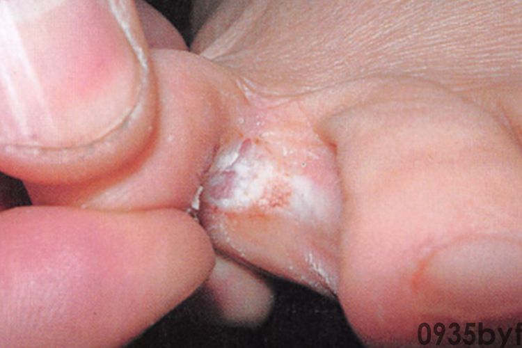 有脚气是什么症状？