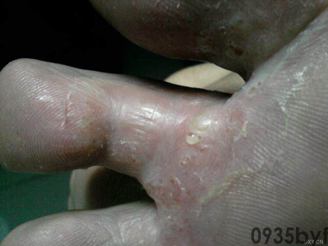 水泡型脚气的治疗方法有哪些