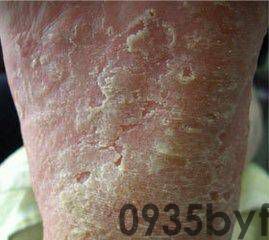 【图】有关足藓症状图片大全4种足藓的类型应及时治疗