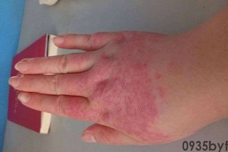 如何祛痘印祛斑