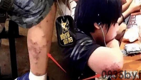 如何有效治疗浸渍糜烂型脚气？