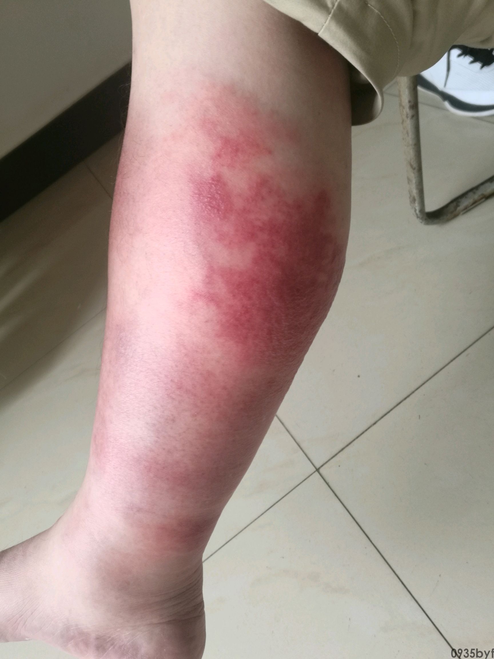 脚气感染的症状-有来医生