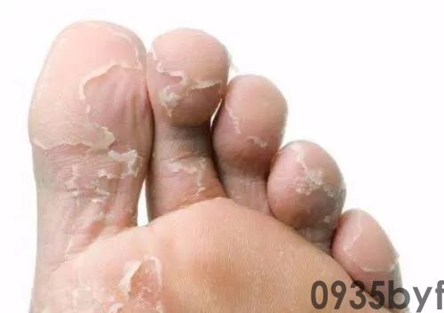 脚气初期症状是什么样的？(图2)