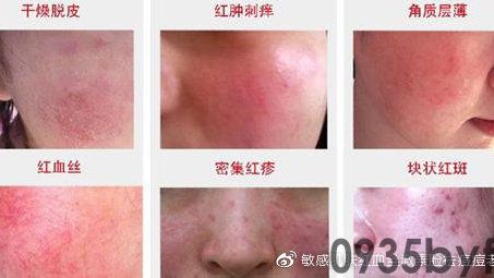 怎么去除红色痘印