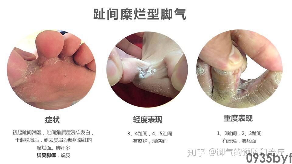 如何分辨湿热脚气和糜烂型脚气?(图1) 如何分辨湿热脚气和糜烂型脚气?
