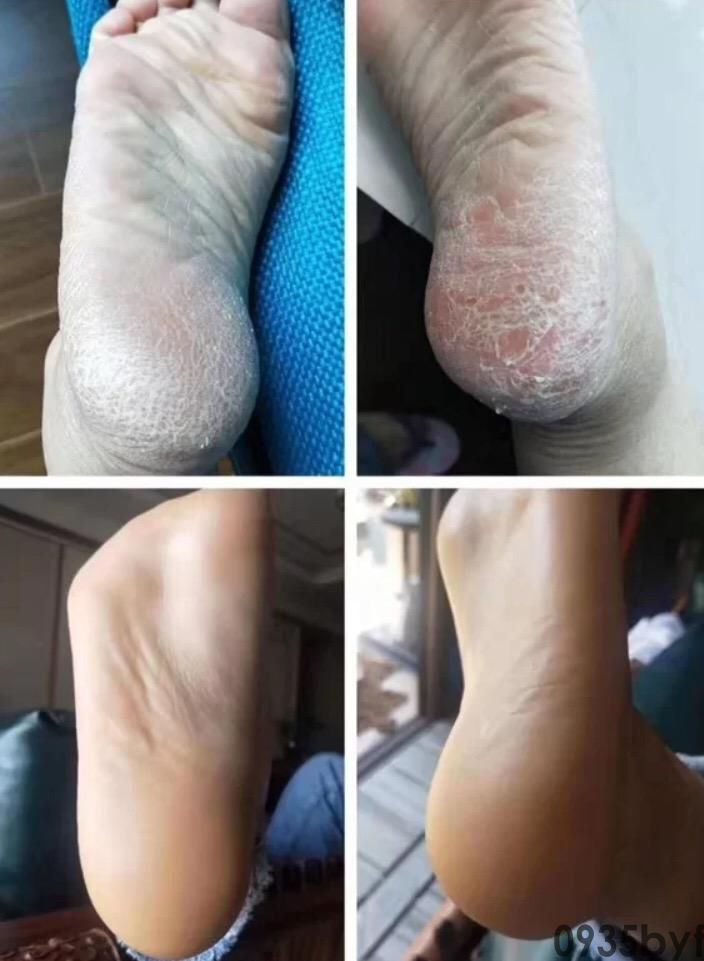 有什么治角化鳞屑型脚气的好药能介绍(图1) 有什么治角化鳞屑型脚气的好药能介绍