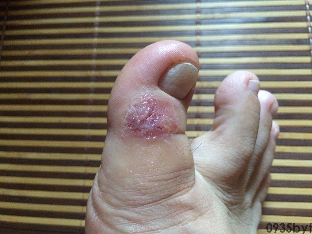 糜烂型脚气的症状求解。