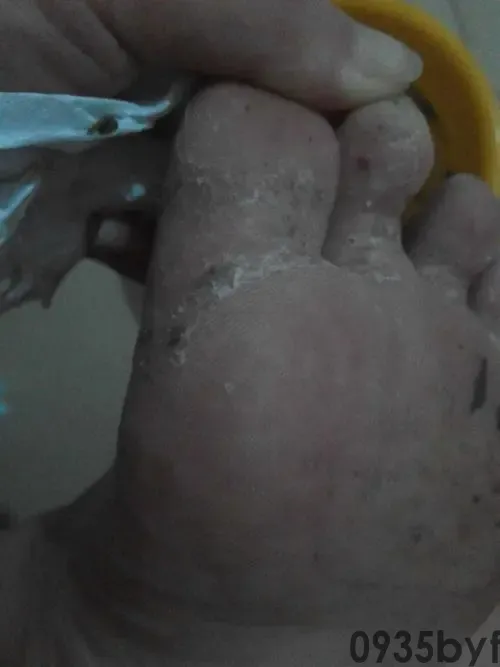 脚气早晨特痒快速止痒(图1) 脚气早晨特痒快速止痒