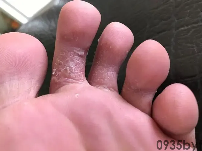 炎天脚气频仍脱皮怎样处置