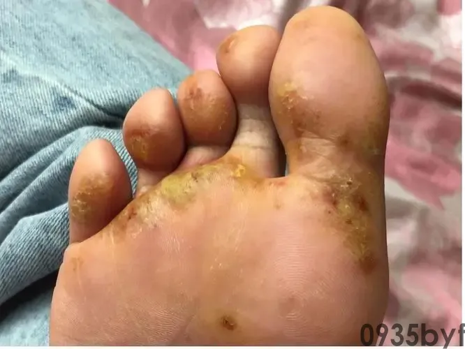 大人脚气有最有用的医治办法吗(图1) 大人脚气有最有用的医治办法吗