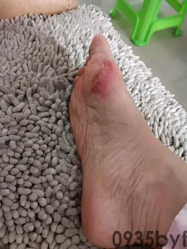 脱皮型脚气怎样治