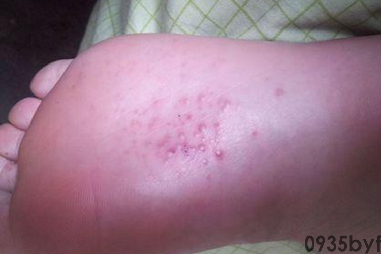 水疱型脚气图片(图1)