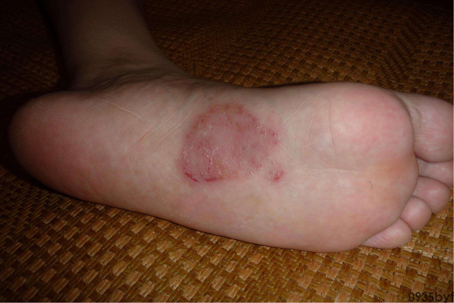 脚气腐败流水还能够洗脚吗