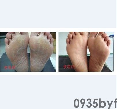 眼皮上长红斑、痒且有白屑是什么缘故原由