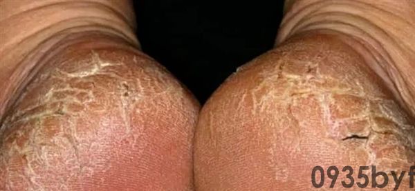 脚后跟总开裂起皮 没必要然是枯燥酿成的！当心这几种病(图1)