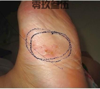 脚背长小水泡。脚气