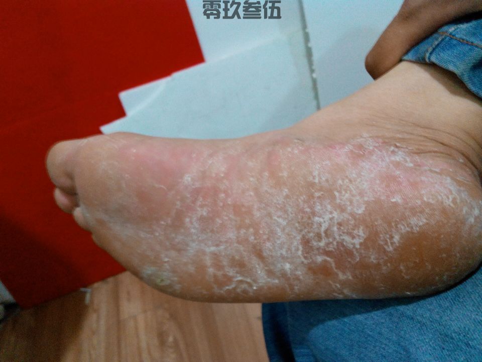 脚痒是脚气吗_王毅大夫的语音科普_好手大夫
