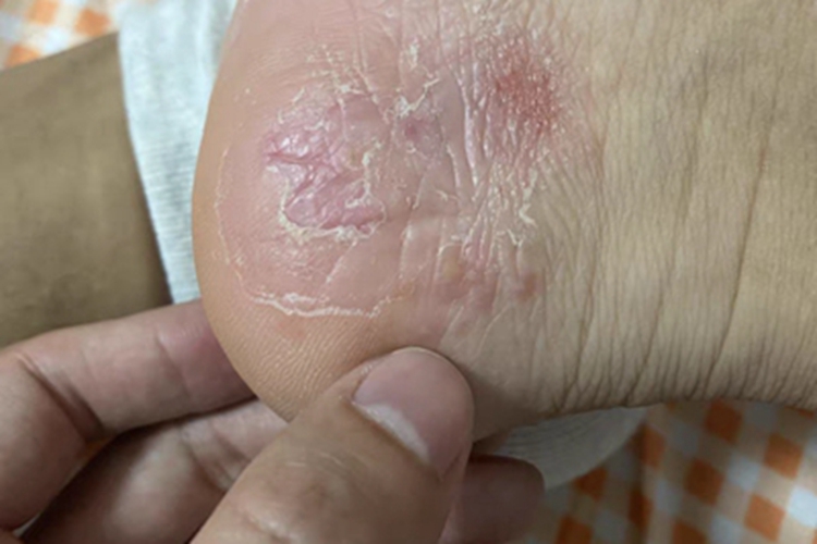 脚气真菌怎样治才气除根