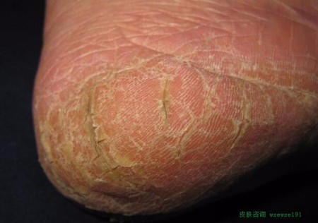 鳞屑角化型足癣脚上死皮零落图