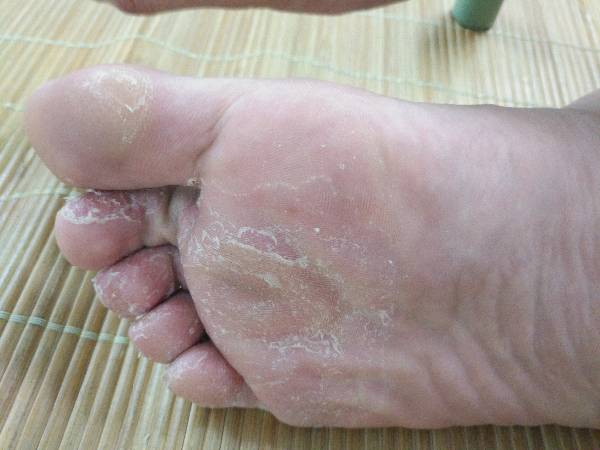炎天重复长脚气且奇痒难耐怎样应对？