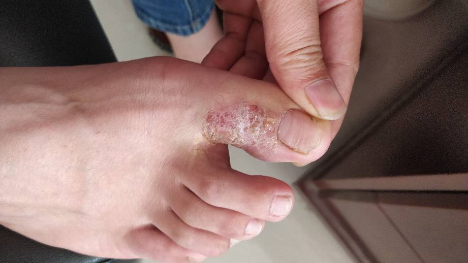 脚气起水泡怎样办