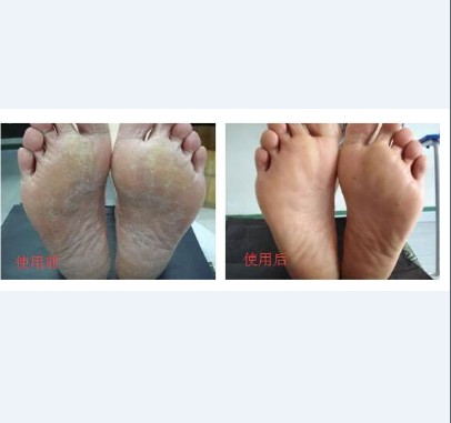 脚气传染用什么抗生素