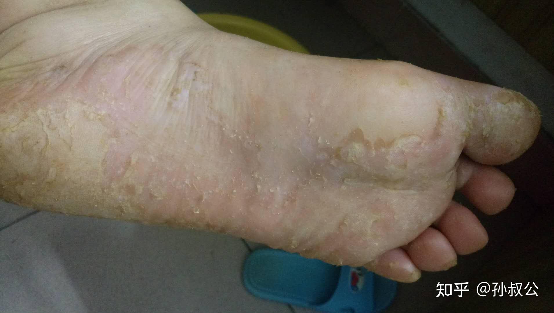 水疱型脚气买什么药膏