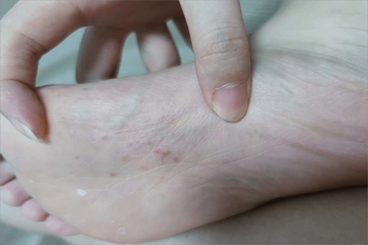 脚气怎样治能除根