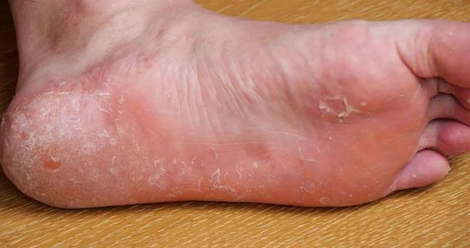 脚气为何反重复复总欠好？能够你踩这些“坑”里了！(图2)