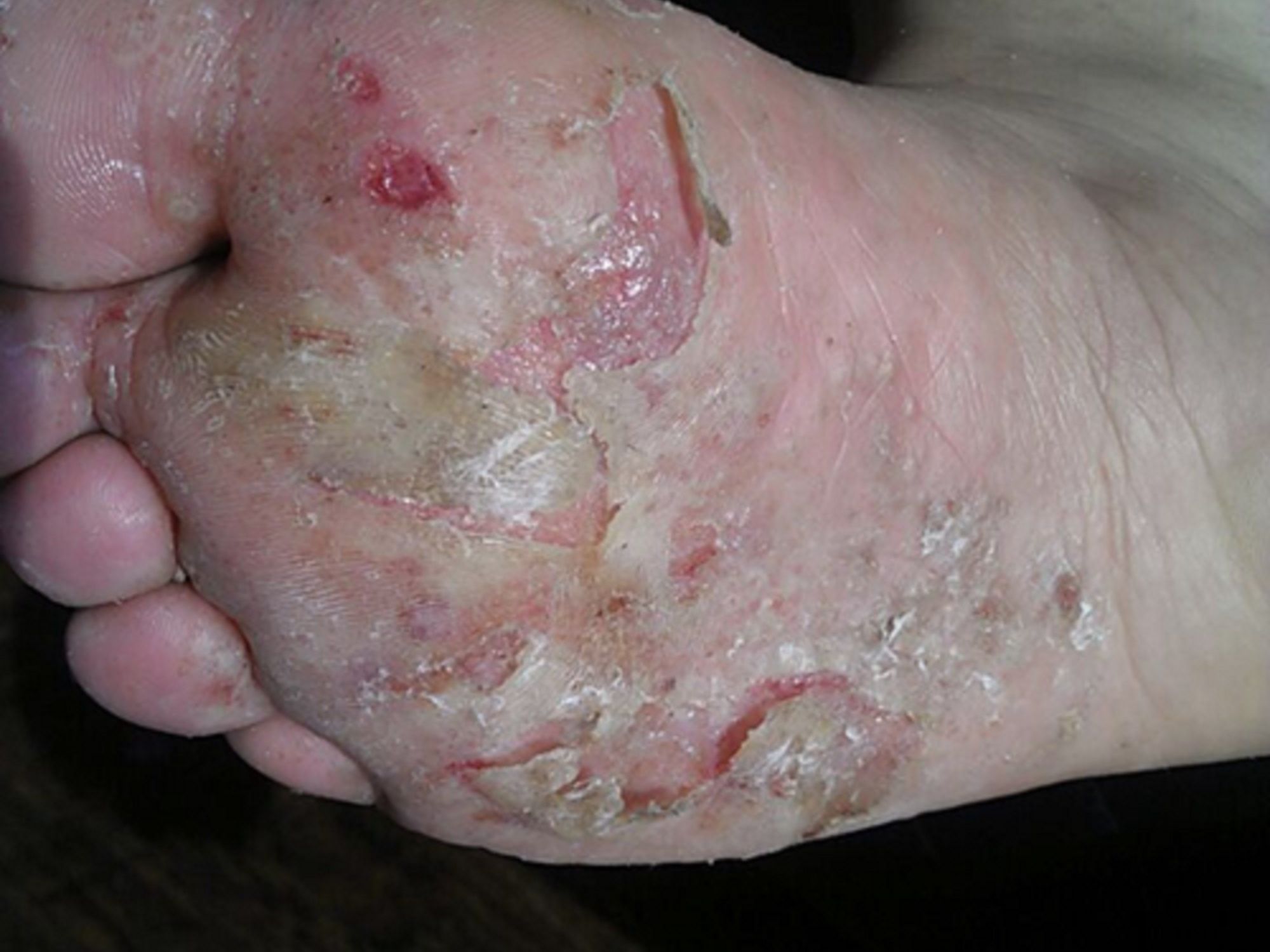 脚气奇痒难忍怎样办？