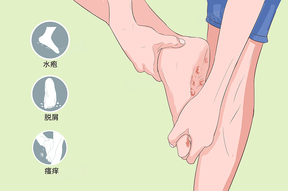 水泡脚气的病症(图1)