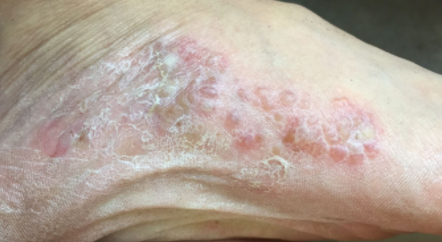 汗疱疹和水泡型脚气怎样分辨