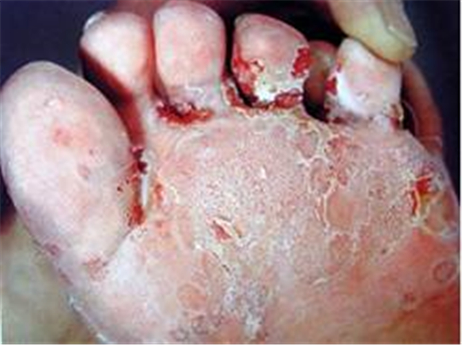 脚气药物市场调研陈述