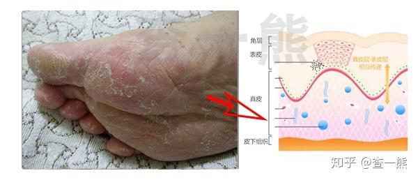 红斑脚气老旧角质软化(图1) 红斑脚气老旧角质软化