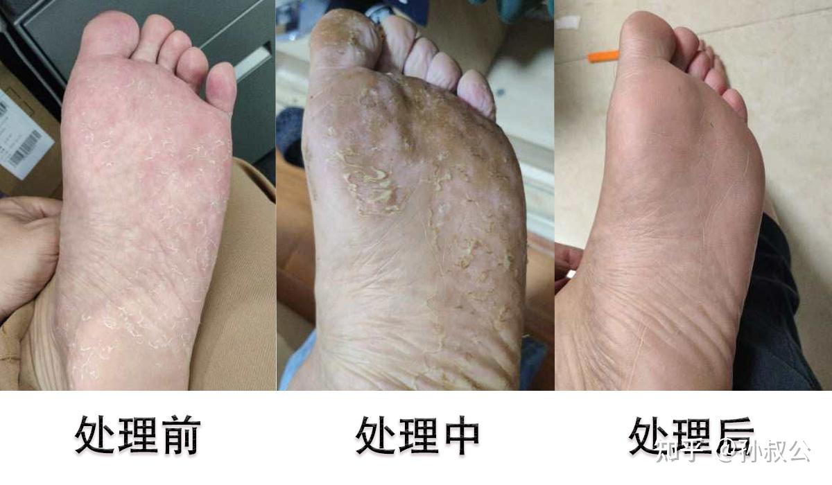 红斑脚气新生皮肤保护