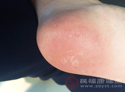 脚部水泡甜食过多加重