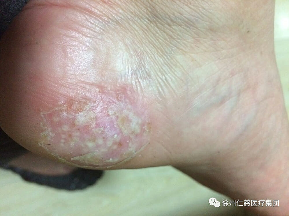 脚部水泡局部免疫薄弱